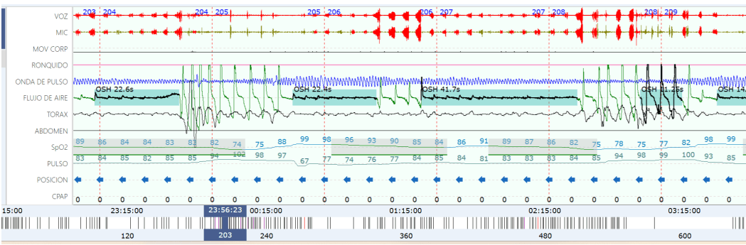 Gráfico de poligrafía mostrando evento de apnea y desaturación