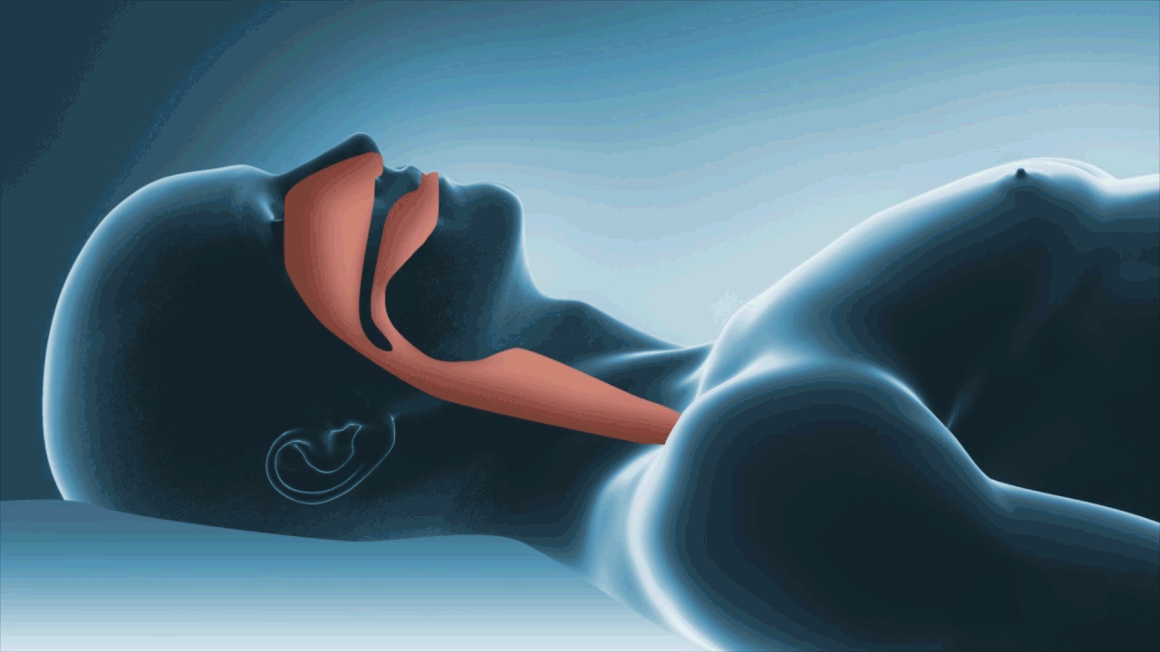 Animación de obstrucción (Apnea)