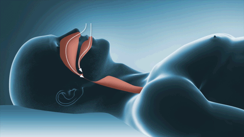 Animación de tratamiento con CPAP